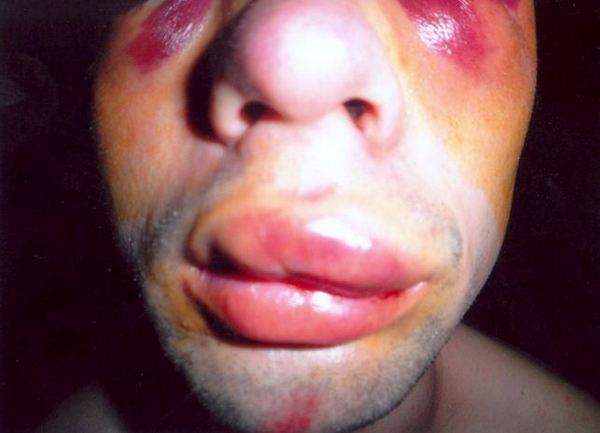 blusrcu.ba-FOTO/BANJALUKA: Trojica boksera Slavije brutalno pretukla studenta