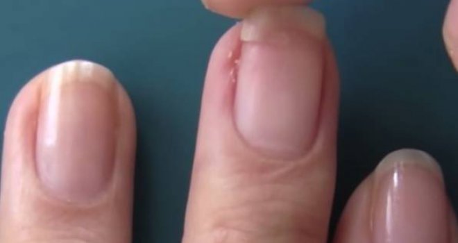 Ako primijetite ove promjene na noktima, odmah idite ljekaru: Neke su bezazlene, a neke ukazuju čak i na rak
