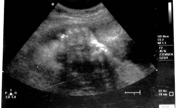 Prije abortusa žene će morati da slušaju kucanje srca svoga fetusa