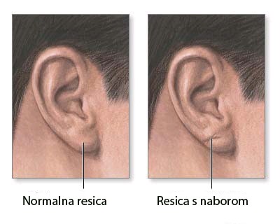 resica