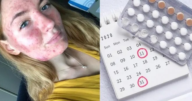Pilule za kontracepciju napravile joj horor: 'Plakala sam, lice mi je krvarilo, ciste su me pekle, boljelo je toliko...'