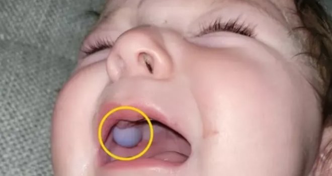 Šokirani doktori mislili da beba ima tumor u ustima sve dok nisu otkrili alarmantnu istinu: 'Budite jako oprezni'